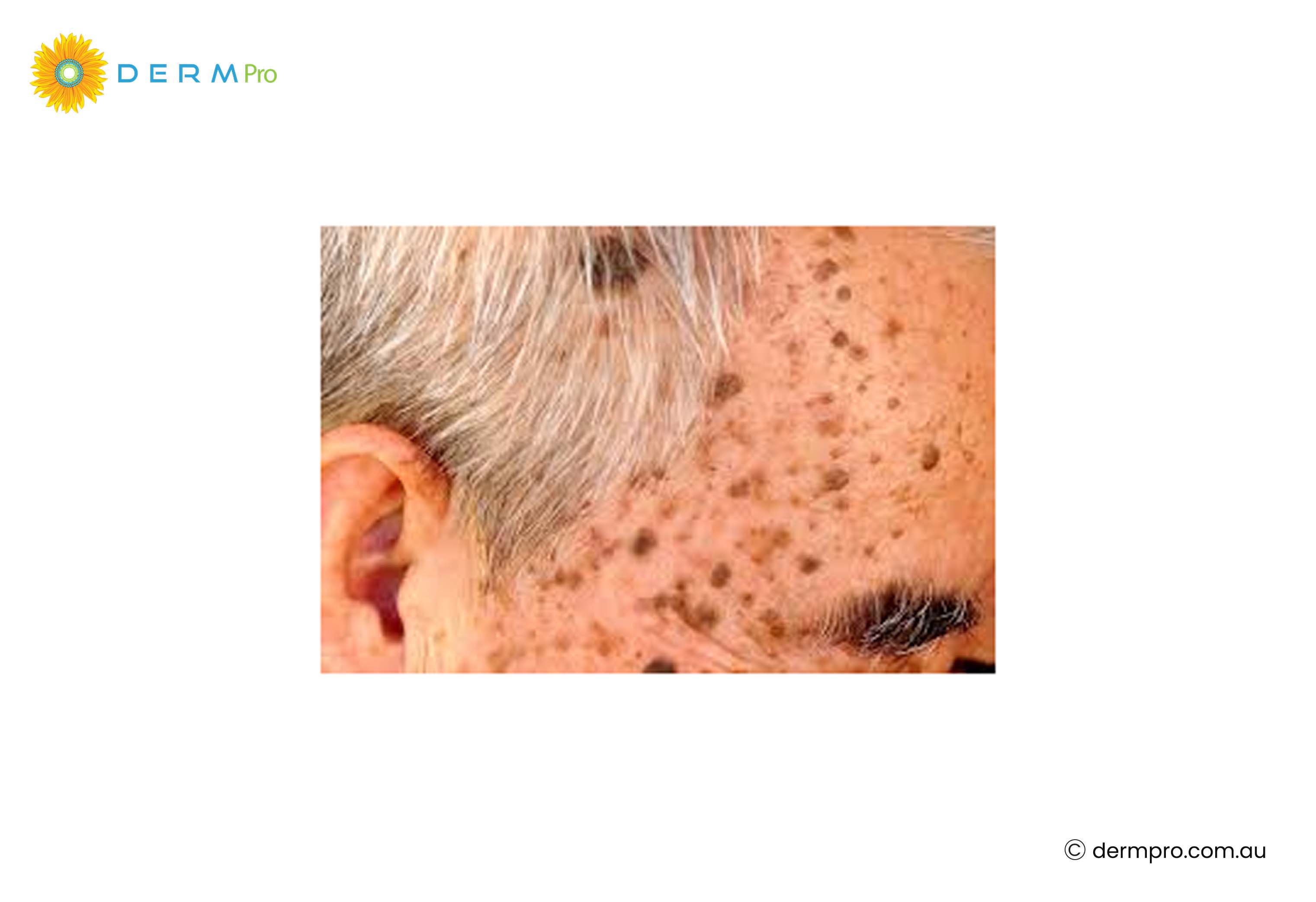 Seborrheic Keratoses images